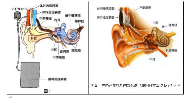 内耳 手術 人工 人工内耳の費用（更生医療と高額医療費制度を使う）